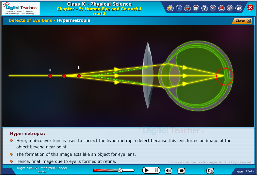 Digital teacher smart class about hypermetropia